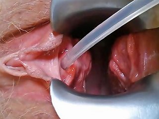 Urethra Catheter Speculum Free Austrian Porn 2f Xhamster